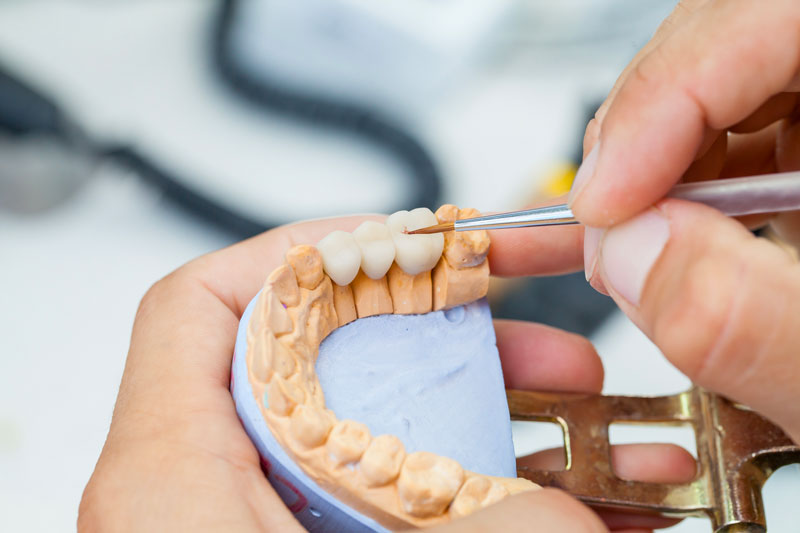 Dentist taking Impressions for Dental Bridge Fabrication in Mississauga, ON