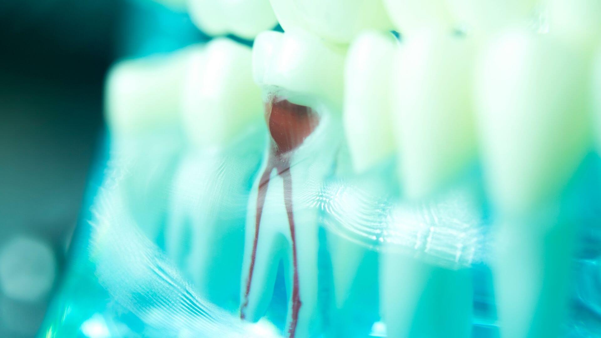 Signs & Symptoms Of Root Canals