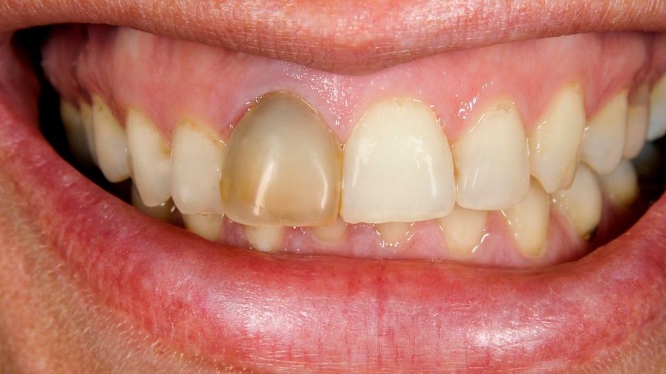 Signs Of A Dead (Non Vital) Tooth