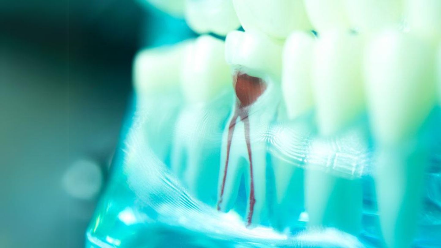 Close Up Of A Root Canal